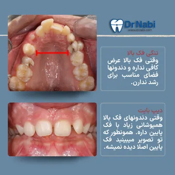 تنگی فک بالا و دیپ بایت؛ ناهنجاری های شایع همراه کلاس 2 نمای اکلوزال فک بالا با تنگی فک بالا و نمای میدلاین دیپ بایت در کودک