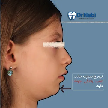 قب بودن فک پایین در نمای نیمرخ کودک نمای نیمرخ صورت کودک با عقب رفتگی چانه و فک پایین