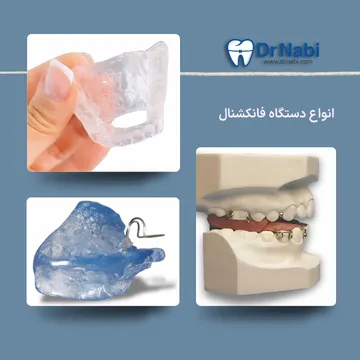 انواع دستگاه فانکشنال برای درمان عقب بودن فک پایین در کودکان انواع دستگاه های فانکشنال شامل مونو بلاک، مونو بلاک با آرک جلو و تویین بلاک در ارتودنسی اطفال