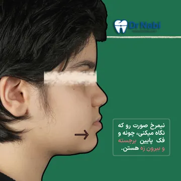 نیم رخ کودک با جلو بودن فک پایین نیم رخ کودک با جلو بودن فک پایین و بیرون زدگی چانه، نمونه بارز کلاس ۳ فک پایین