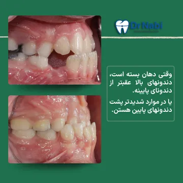 چگونه جلو بودن فک پایین را تشخیص دهیم دو نمونه اوکلوژن سمت راست؛ یکی با تماس تقریبا نوک به نوک دندانها و کمی جلو بودن فک پایین، دیگری با جلو بودن واضح فک پایین و پشت افتادن دندانهای بالایی.