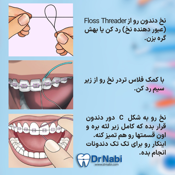 عبور دادن نخ با فلاس تردر از زیر سیم و تمیز کردن فضای بین دندان ها 