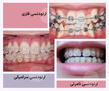 مقایسه انواع ارتودنسی؛ فلزی، سرامیکی و الاینر شفاف تصویر مقایسهای انواع ارتودنسی شامل ارتودنسی فلزی، ارتودنسی سرامیکی و ارتودنسی نامرئی با الاینر شفاف