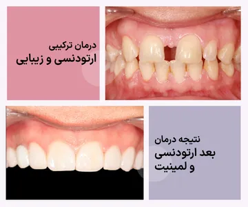 نتیجه نهایی درمان ترکیبی ارتودنسی و لمینیت در مقایسه با وضعیت اولیه مقایسه نمای روبروی دندانها قبل از درمان و نتیجه نهایی پس از ارتودنسی و لمینیت