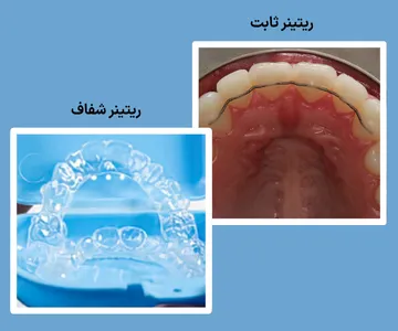 ریتینر ثابت و متحرک در ارتودنسی برای حفظ نتیجه درمان تصویر ریتینر ثابت و متحرک ارتودنسی برای تثبیت نتیجه درمان و جلوگیری از برگشت دندانها