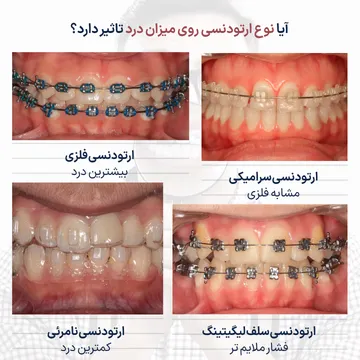 تصویر مقایسه ای میزان درد در انواع ارتودنسی شامل براکت فلزی، براکت سرامیکی، سلف لیگیت و الاینر شفاف که تفاوت هر روش از نظر شدت درد و راحتی بیمار را نشان میدهد.