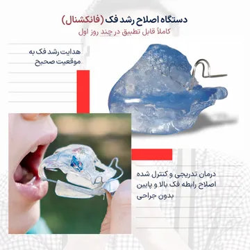 تصویر دستگاه فانکشنال ارتودنسی کودکان برای اصلاح رشد فک بالا و پایین که با اعمال نیروی تدریجی باعث بهبود رابطه فکی شده و معمولاً درد خفیف و موقتی ایجاد میکند.