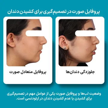 مقایسه پروفایل متعادل صورت با جلوزدگی دندان‌ها؛ یکی از عوامل مهم در تصمیم‌گیری برای ارتودنسی با کشیدن یا بدون کشیدن دندان