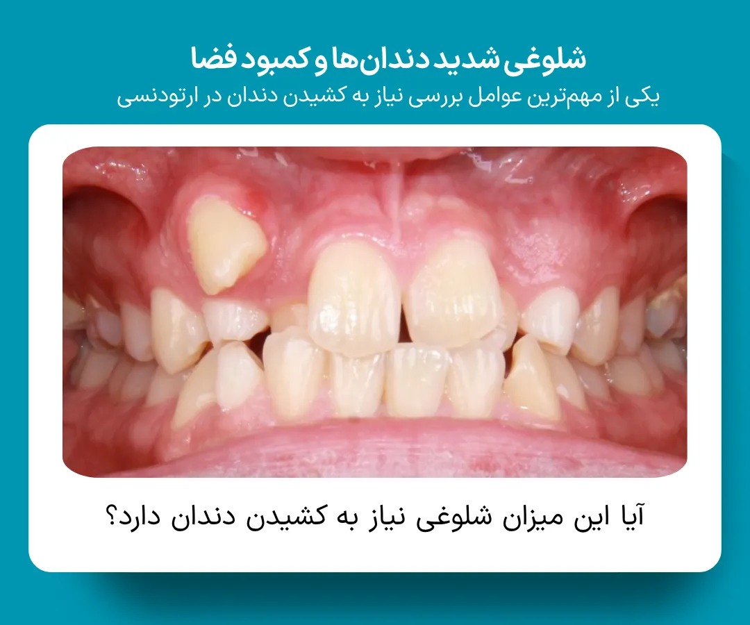 نمونه ازدحام دندان‌های فک پایین ناشی از کمبود فضای قوس دندانی که ممکن است در برنامه‌ریزی درمان ارتودنسی نیاز به ایجاد فضا یا کشیدن دندان را مطرح کند