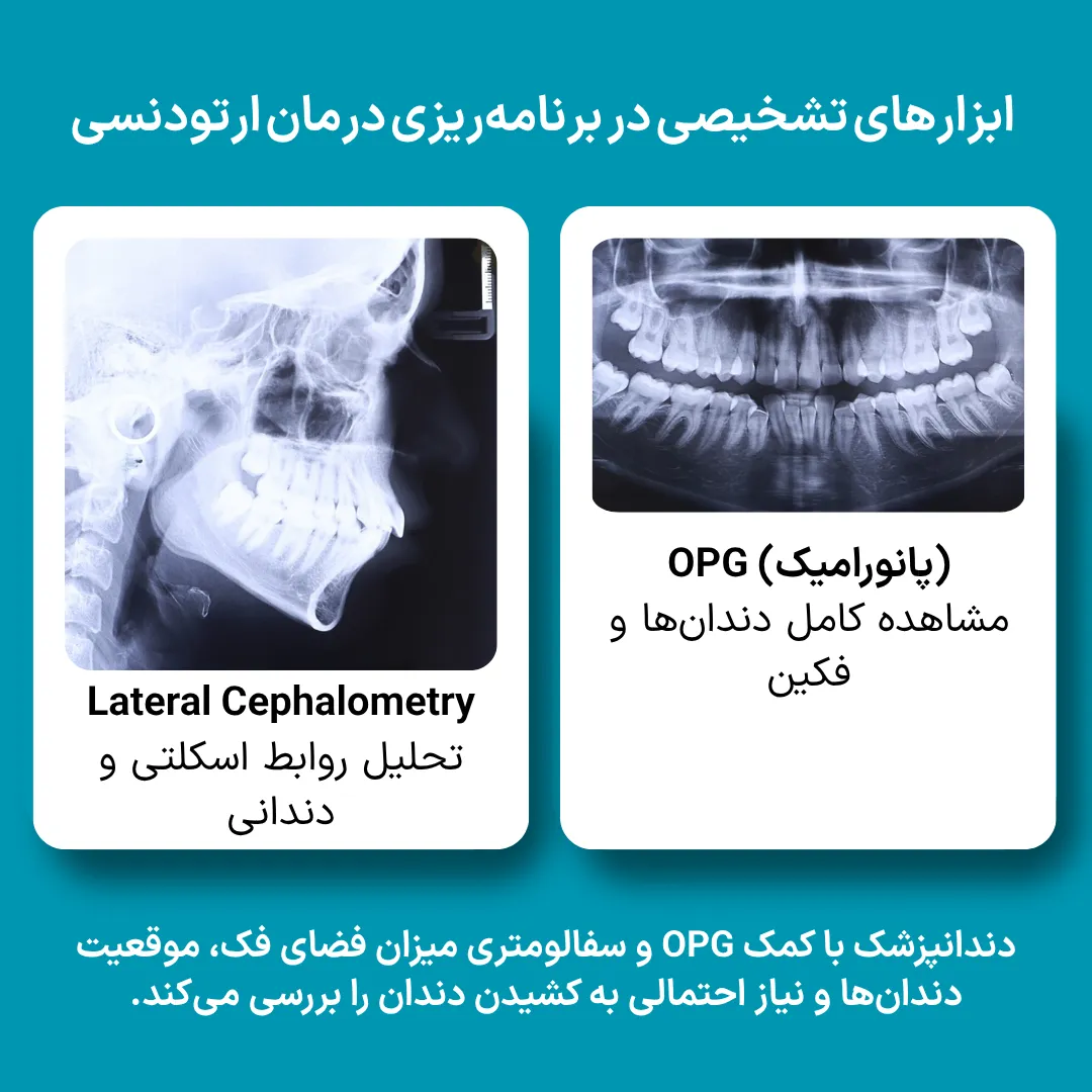 نمونه عکس OPG و لترال سفالومتری برای تشخیص کمبود فضا و بررسی نیاز به کشیدن دندان قبل از ارتودنسی