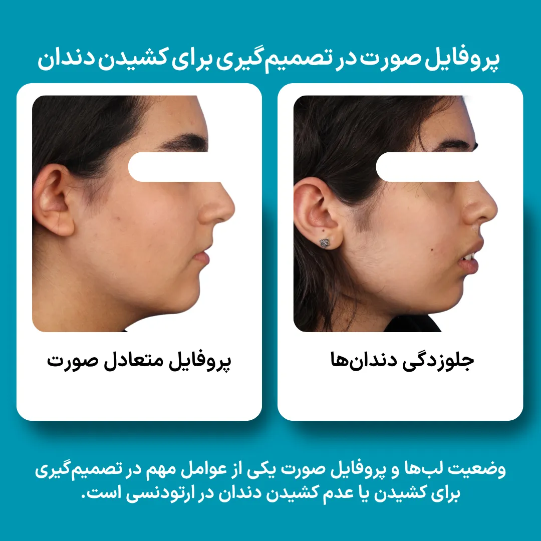 مقایسه پروفایل متعادل صورت با جلوزدگی دندان‌ها؛ یکی از عوامل مهم در تصمیم‌گیری برای ارتودنسی با کشیدن یا بدون کشیدن دندان