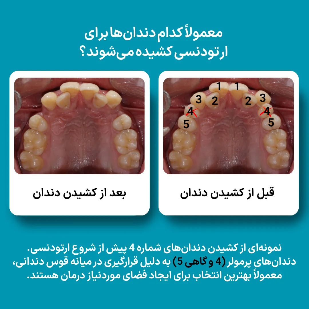 نمونه کشیدن دندان‌های پرمولر شماره ۴ پیش از ارتودنسی؛ دندان‌هایی که معمولاً برای ایجاد فضای درمان انتخاب می‌شوند