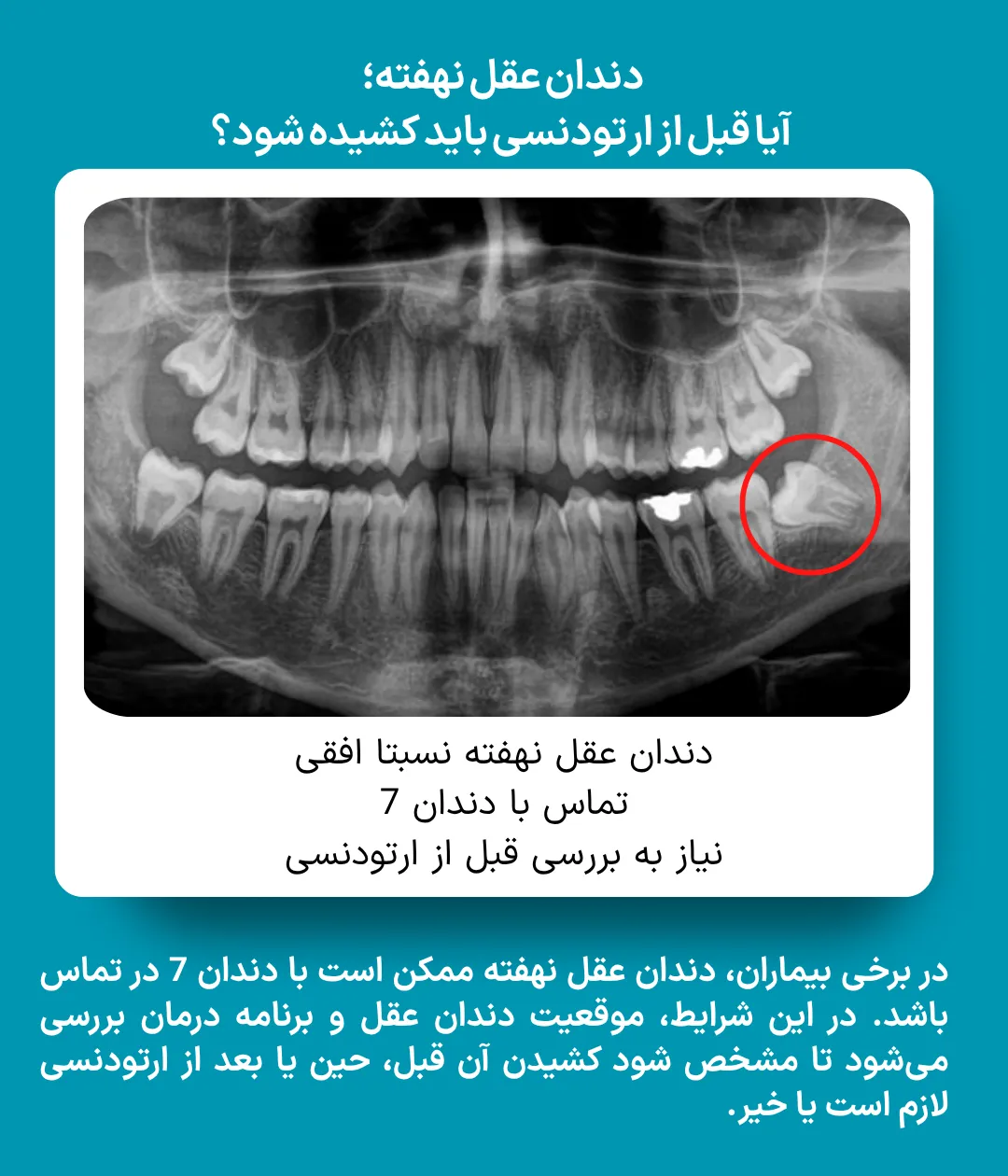 رادیوگرافی OPG بیمار با دندان عقل نهفته افقی در تماس با دندان ۷ برای بررسی نیاز به کشیدن دندان قبل از ارتودنسی