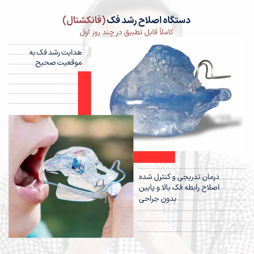 تصویر دستگاه فانکشنال ارتودنسی کودکان برای اصلاح رشد فک بالا و پایین که با اعمال نیروی تدریجی باعث بهبود رابطه فکی شده و معمولاً درد خفیف و موقتی ایجاد میکند.
