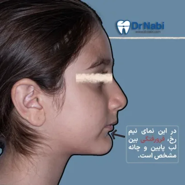 نمای نیم رخ و ناحیه لب پایین و چانه نمای نیم رخ کودک با فرورفتگی بین لب پایین و چانه