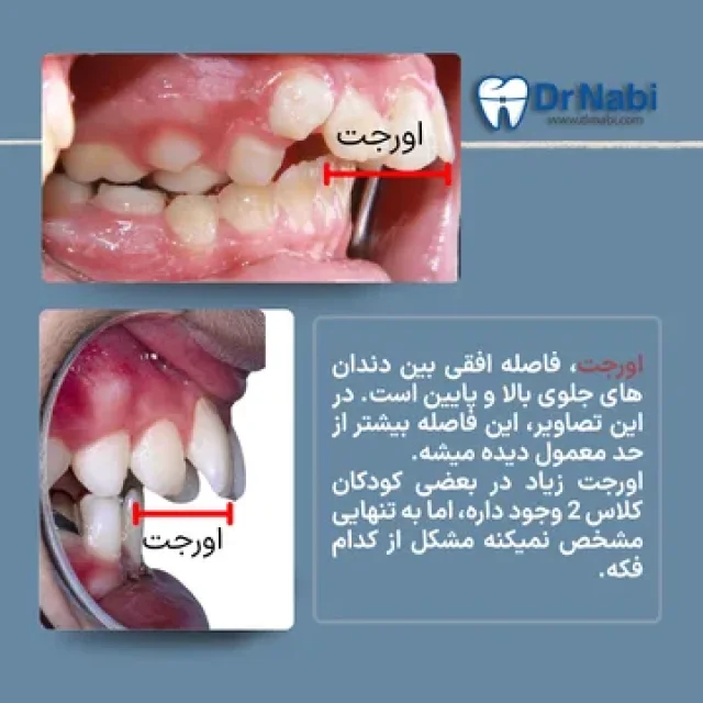 تنگی فک بالا و دیپ بایت؛ ناهنجاری های شایع همراه کلاس 2 نمای قوس دندانی بالا و پوشش زیاد دندان های جلویی پایین در دو تصویر داخل دهان