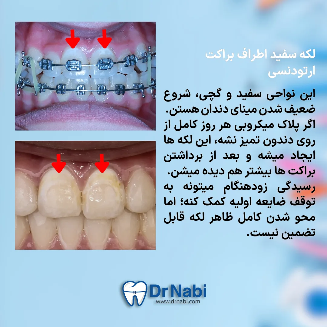 ضایعه سفید گچی روی مینای دندان ناشی از دمینرالیزاسیون در ارتودنسی