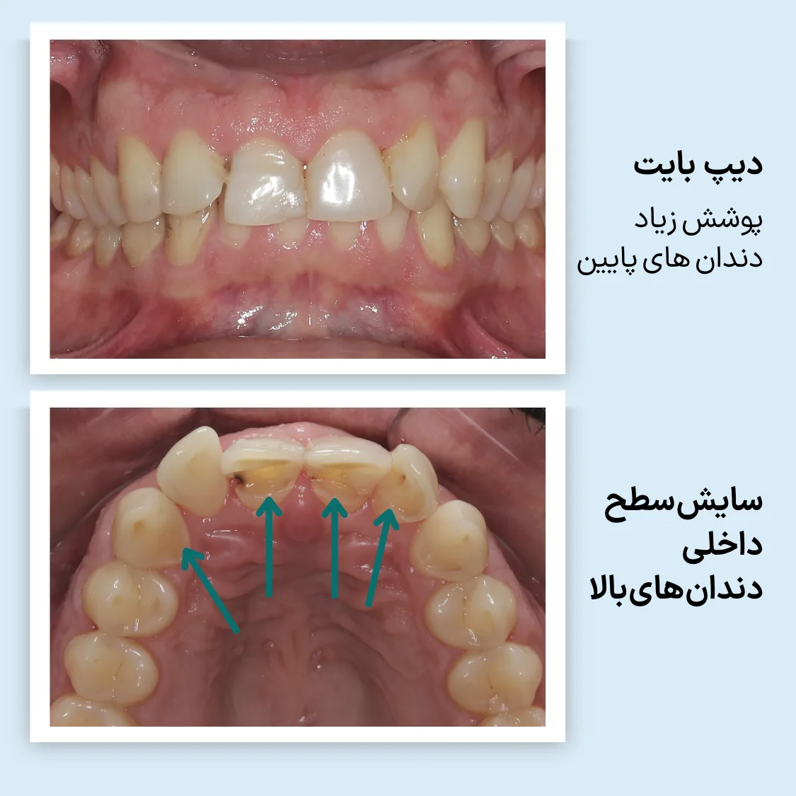 نمای روبروی دیپ بایت و نمای داخلی دندان های بالا با محل های سایش مشخص شده
