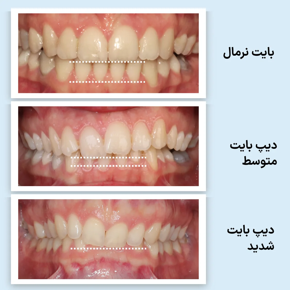 مقایسه میزان دیده شدن دندان های جلوی پایین در سه نمای بایت