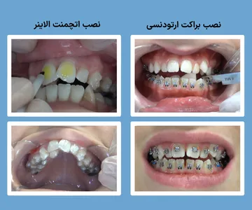 مراحل نصب براکت ارتودنسی و چسباندن اتچمنت الاینر روی دندان ها