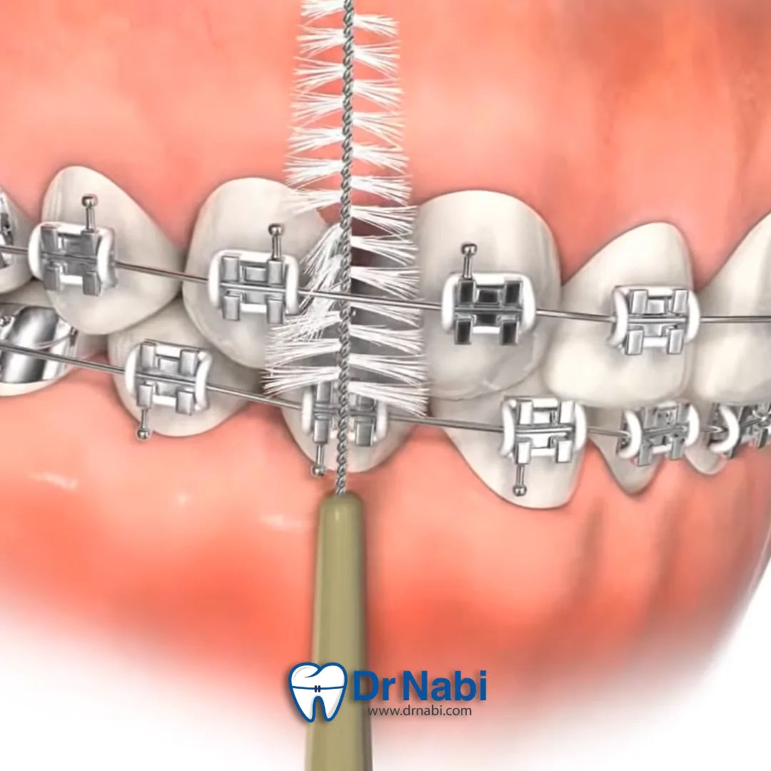 وارد کردن مسواک بین دندانی بین براکت ها برای حذف پلاک و خرده غذا