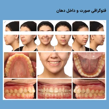 مجموعه عکس های صورت از روبرو و نیم رخ، لبخند و نماهای داخل دهان برای پرونده ارتودنسی