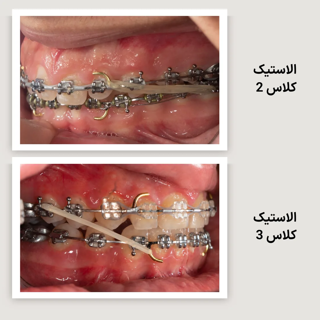 کش کلاس 2 در تصویر بالا و کش کلاس 3 در تصویر پایین با ارتودنسی ثابت