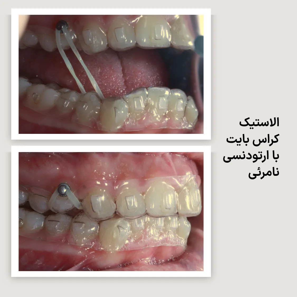 کش بین فکی برای اصلاح کراس بایت همراه الاینر شفاف، در دو نمای دهان