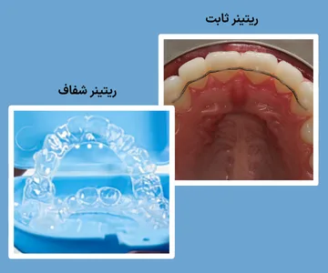 نگهدارنده شفاف متحرک و ریتینر ثابت متصل به پشت دندان های جلو