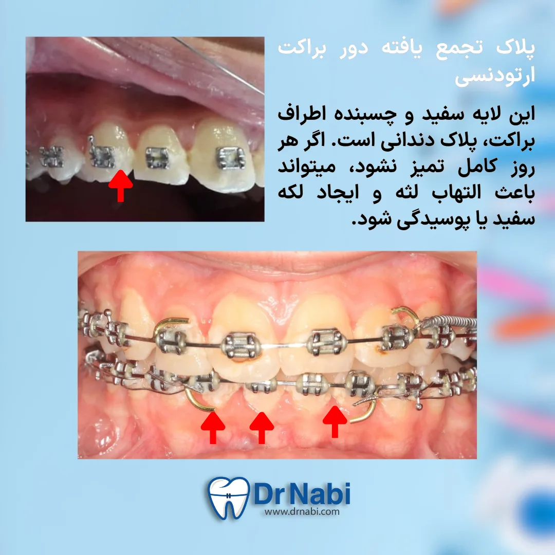 پلاک میکروبی تجمع یافته دور براکت ها و التهاب لثه ناشی از آن