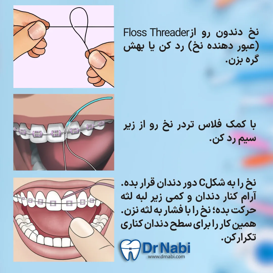 عبور دادن نخ با فلاس تردر از زیر سیم و تمیز کردن فضای بین دندان ها