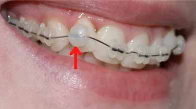 موم ارتودنسی روی براکت برای جلوگیری از تحریک لثه و گونه