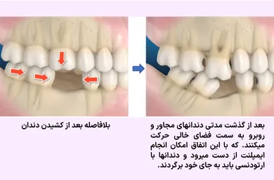 حرکت دندان های مجاور و روبرو به داخل فضای خالی پس از کشیدن دندان