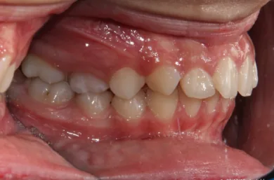 بررسی رابطه مولر اول دائمی در بیمار کلاس 2