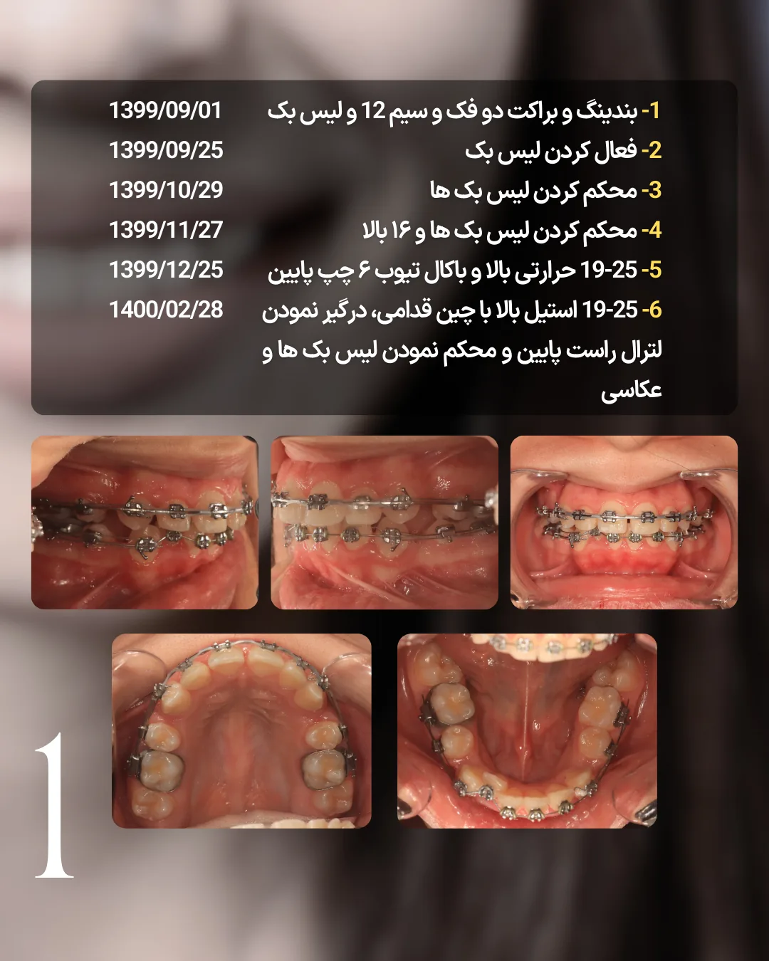 مراحل اولیه درمان کیس اکس 4 از باندینگ و Laceback تا سیم های مستطیلی در ارتودنسی ثابت