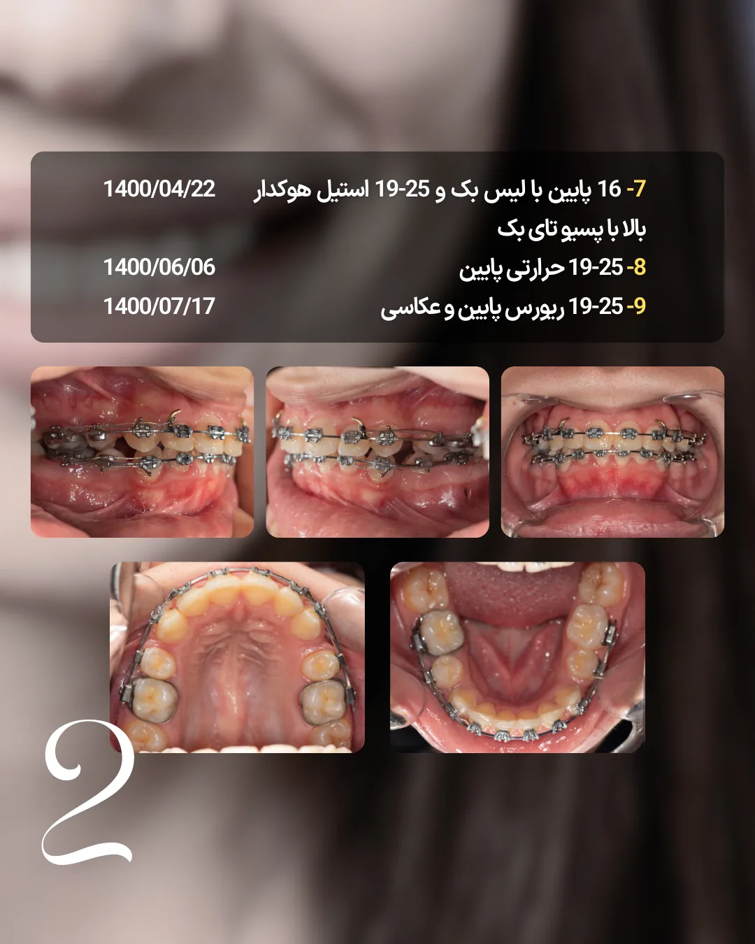 ادامه درمان کیس اکس 4 با سیم استیل هوک دار، Passive Tieback و آماده سازی دو قوس