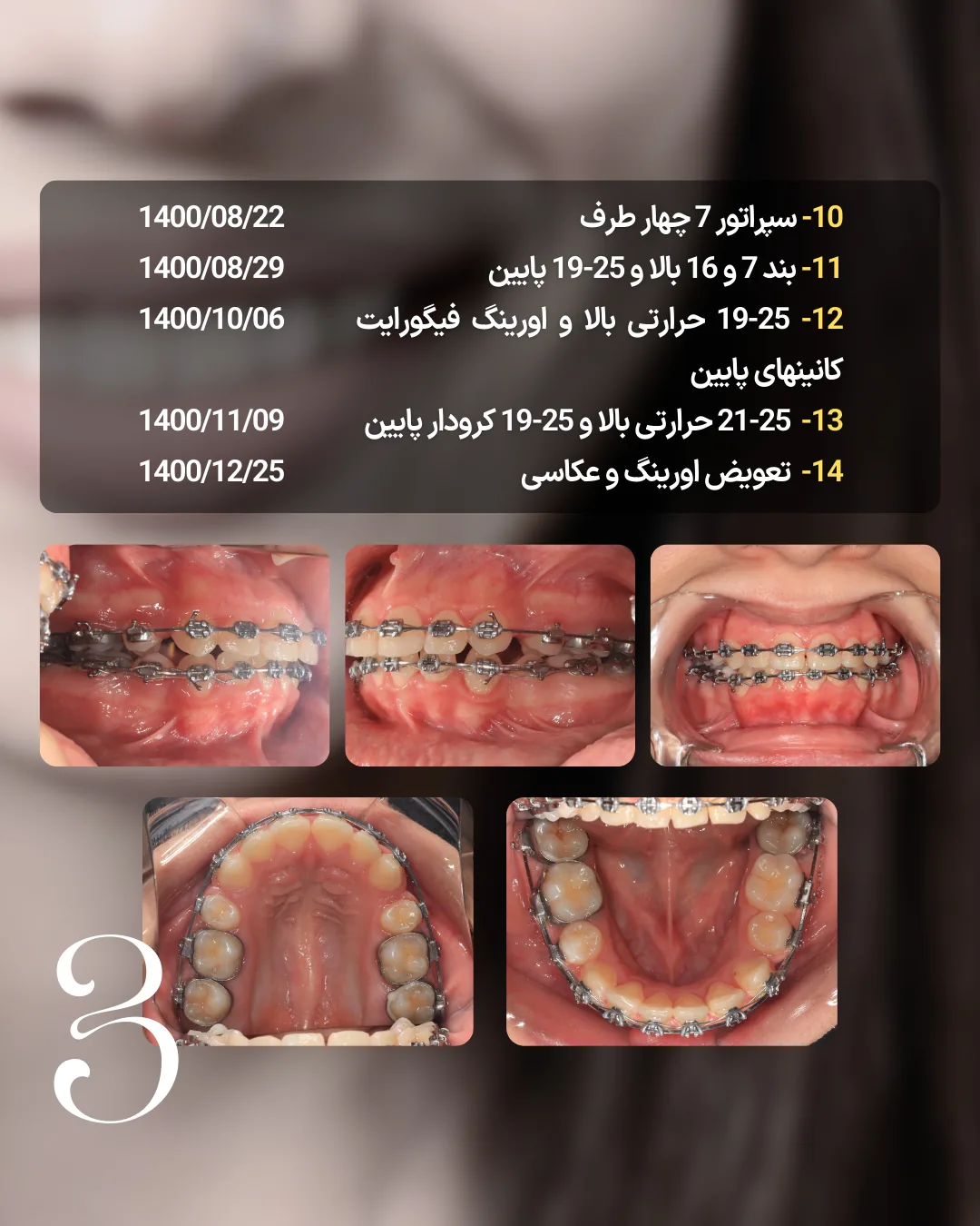 ادامه درمان کیس اکس 4 با بند مولر دوم و کنترل سیم های دو فک پیش از بستن فضا