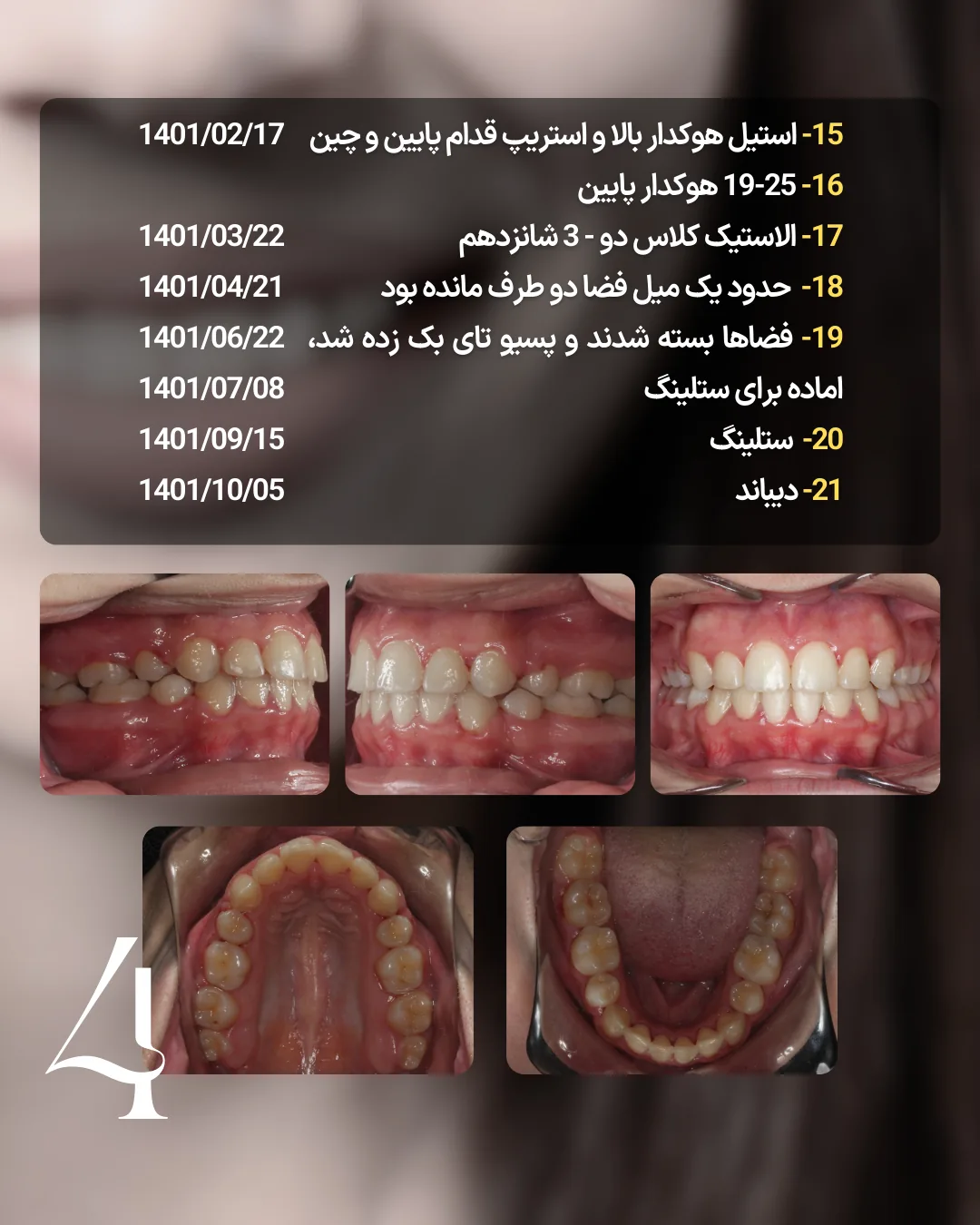 مرحله بستن فضا در کیس اکس 4 با سیم هوک دار، الاستیک، Passive Tieback، Settling و Debond