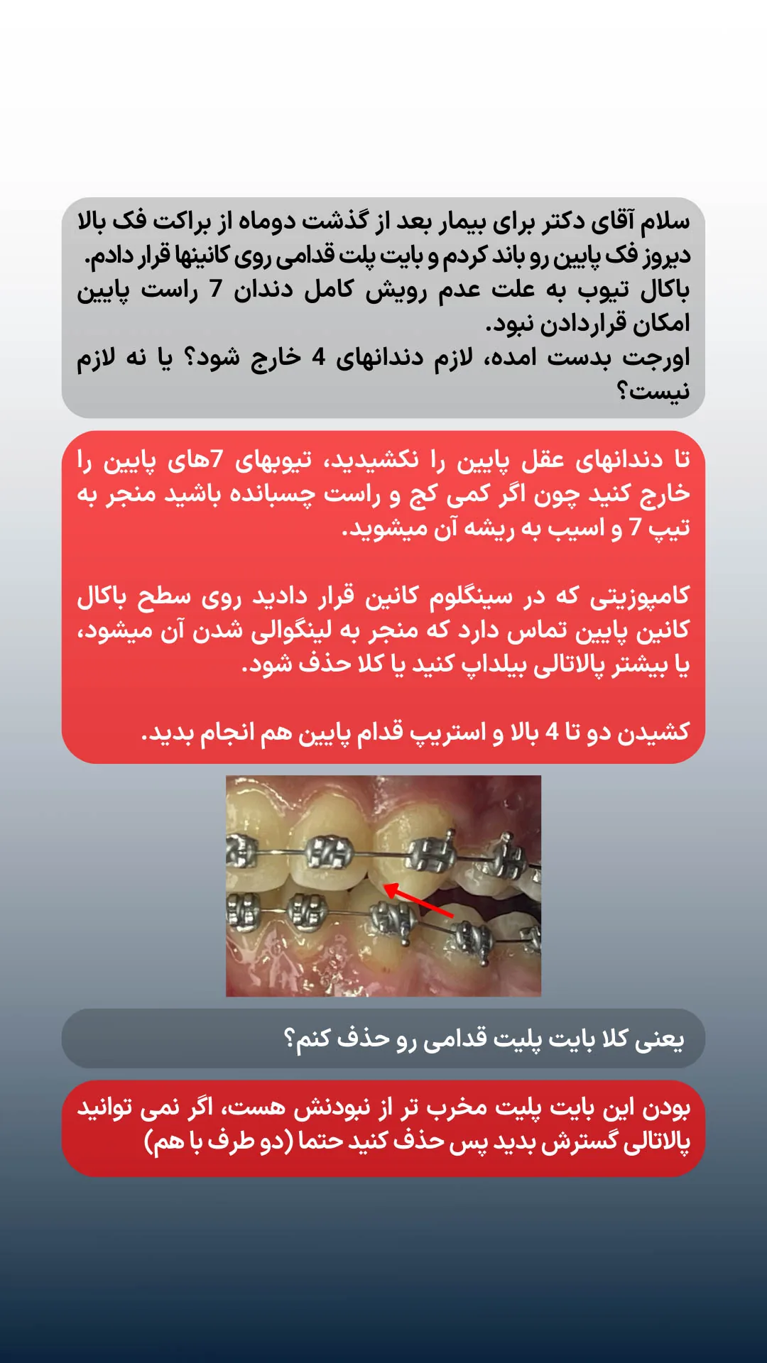 مشاوره درباره تیوب مولر دوم پایین، بایت پلیت، کشیدن 4های بالا و استریپ قدام پایین