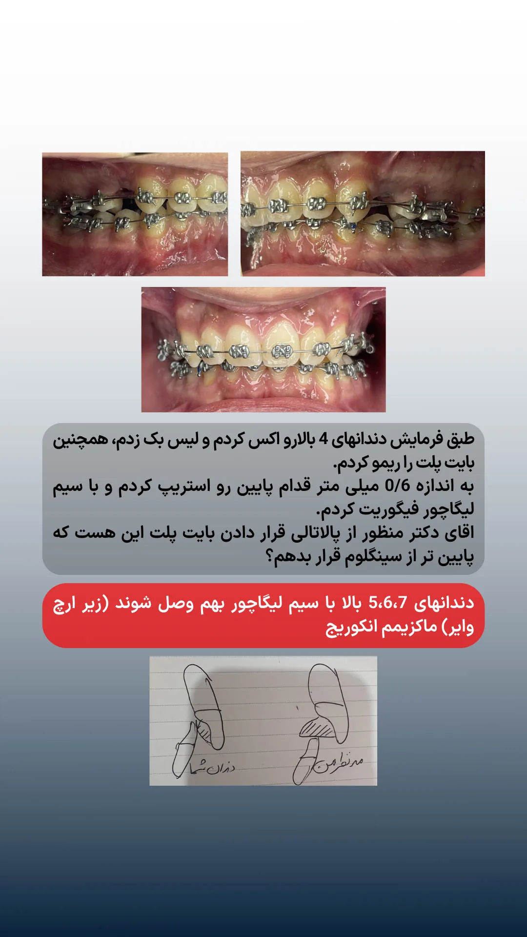 پرسش درباره استریپ قدام پایین، بایت پلیت و ماکزیمم انکوریج فک بالا