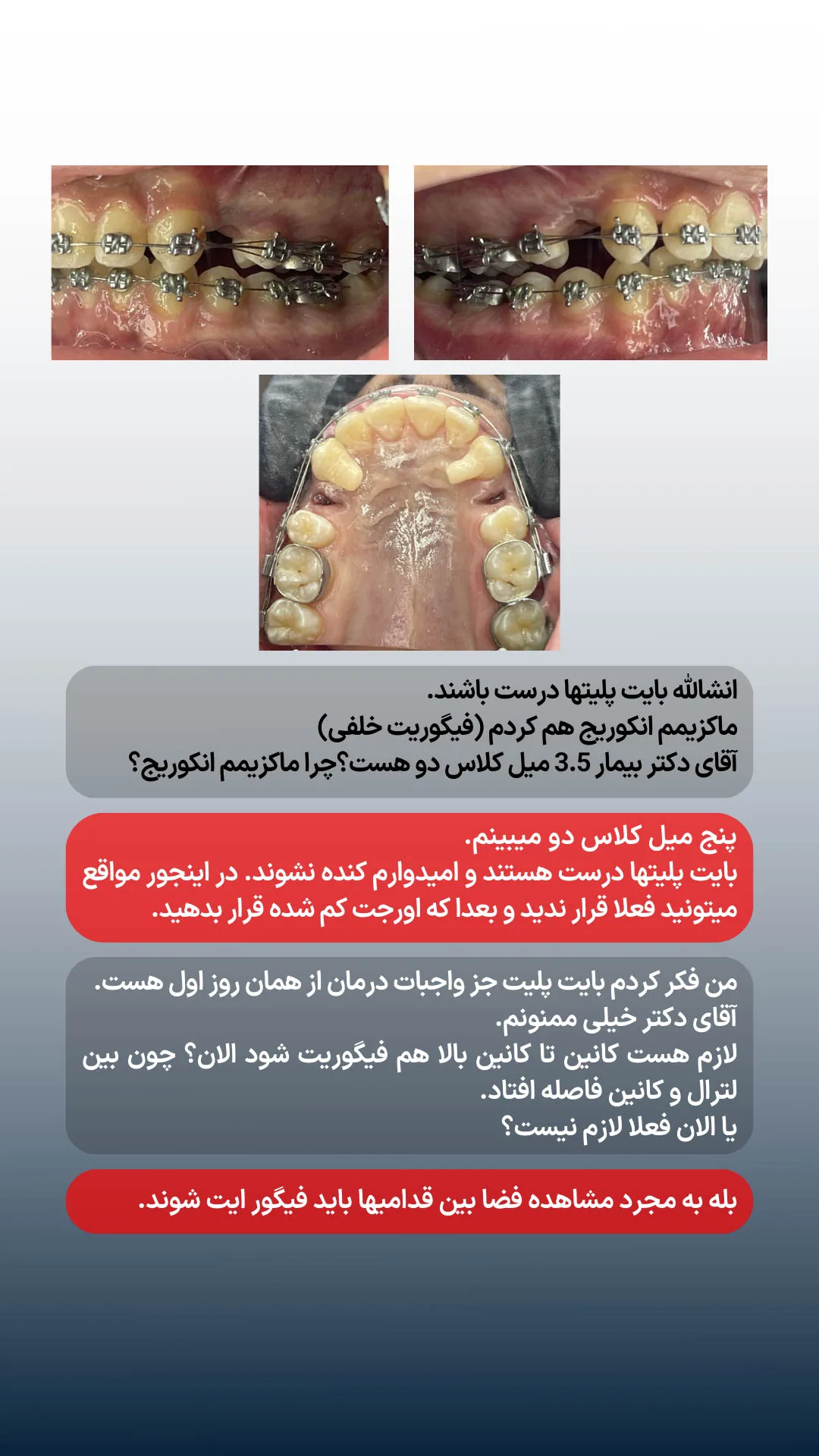 بررسی بایت، ماکزیمم انکوریج و رابطه کلاس 2 در ادامه درمان