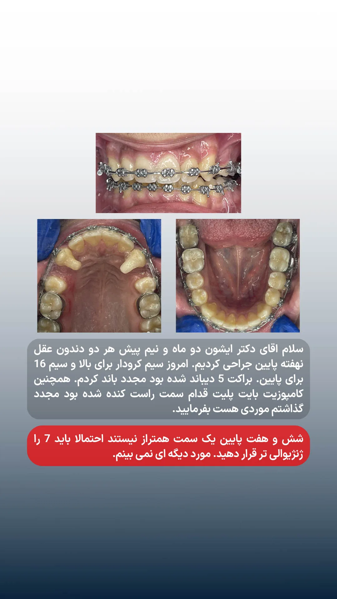 پیگیری ارتودنسی پس از خارج کردن دندان های عقل و بررسی تراز مولرهای پایین