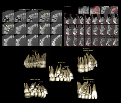تصویر سه بعدی CBCT فک و دندان ها در یک مورد ارتودنسی