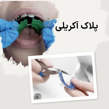 تضویر پلاک آکریلی ارتودنسی اطفال نما پلاک آکریلی ارتودنسی اطفال داخل دهان ونما کلوزآپ پلاک آکریلی دردست دندانپزشک در یک تصویر
