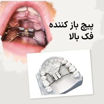 تصویر پیچ باز کننده فک بالا (هایرکس) نما اکلوزال پیچ باز کننده فک بالا (هایرکس) از داخل دهان ونما کلوزآپ هایرکس روی کست در یک تصویر