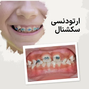 براکتهای ارتودنسی روی دندانهای جلویی- ارتودنسی سکشنال نما ارتودنسی سکشنال روی دندانهای جلویی کودک و نما میدلاین دهانی کودک با براکتهای ارتودنسی روی دندانهای قدامی در یک تصویر