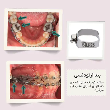 سه نما از بندهای ارتودنسی که روی دندان های خلفی قرار میگیرن؛ نمای اکلوژن، نمای اکلوزال و تصویر خود بند در یک فریم
