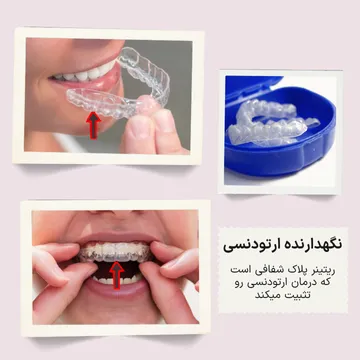 سه تصویر از ریتینر ارتودنسی پس از پایان درمان شامل دو تصویر ریتینر روی دندان ها و یک تصویر از ریتینر داخل جاپلاکی