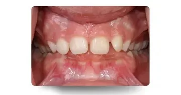 نمای داخل دهان بیمار با دیپ بایت (Deep Bite) قبل از درمان ارتودنسی