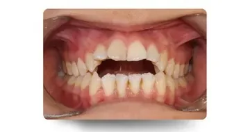 نمای کلینیکی اوپن بایت (Open Bite) قدامی قبل از شروع درمان ارتودنسی
